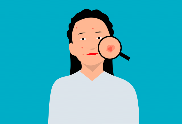 Kulit Berjerawat? Hindari 5 Kandungan Skincare ini!!