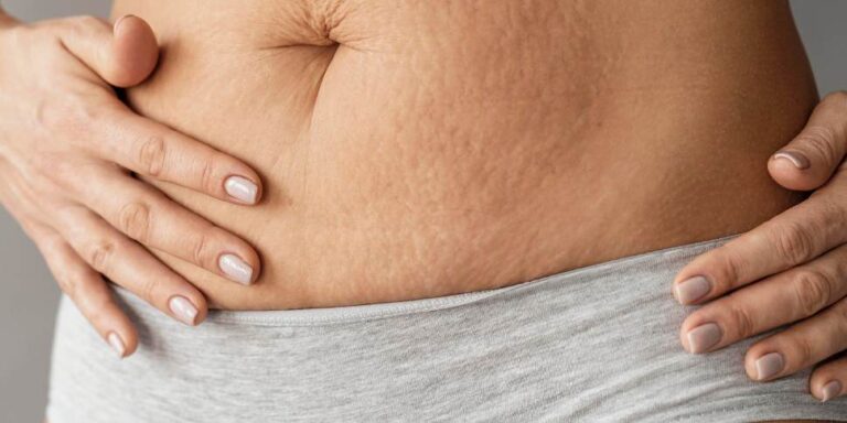stretch mark