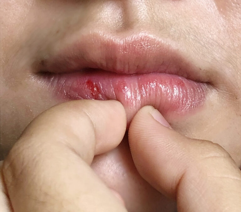 fakta menarik mencabuti kulit bibir menurut psikologi