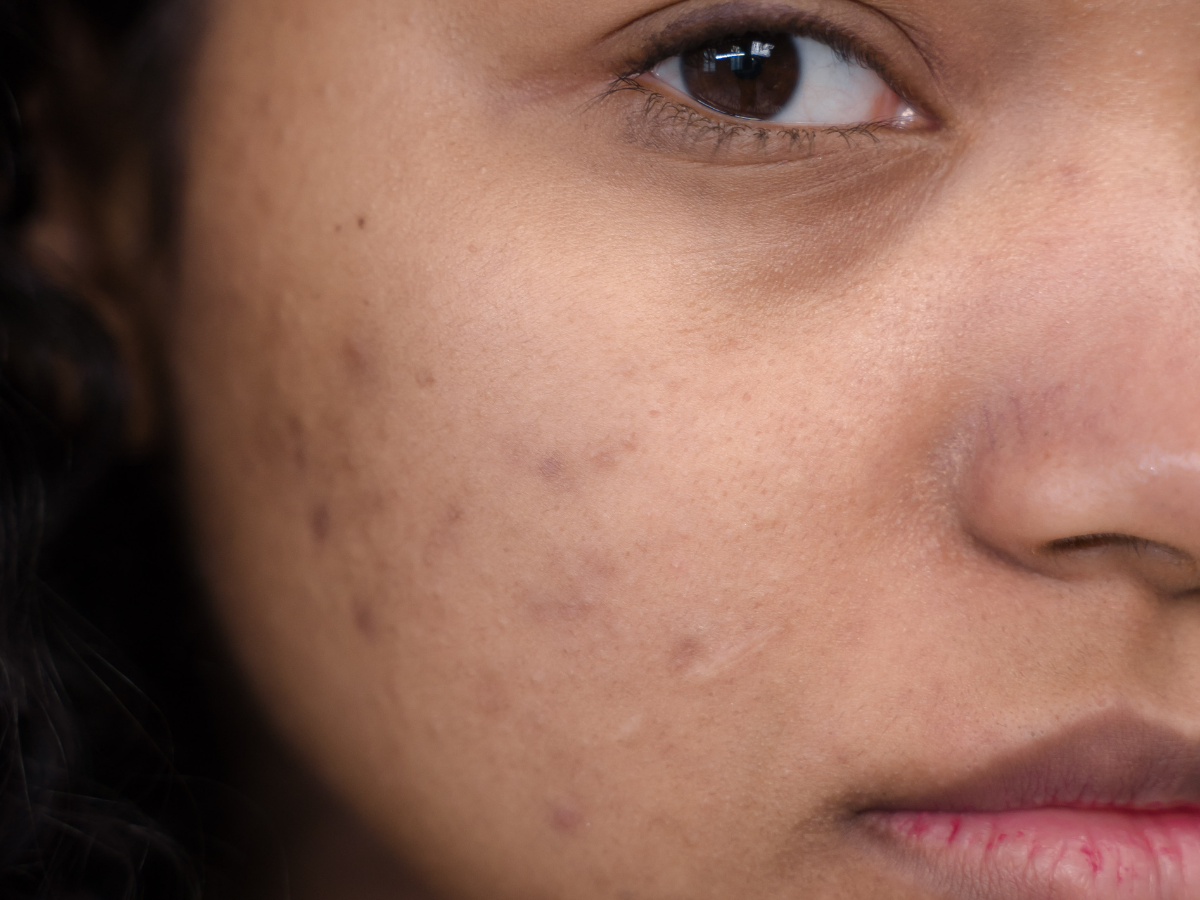 eksfoliasi wajah agar wajah halus