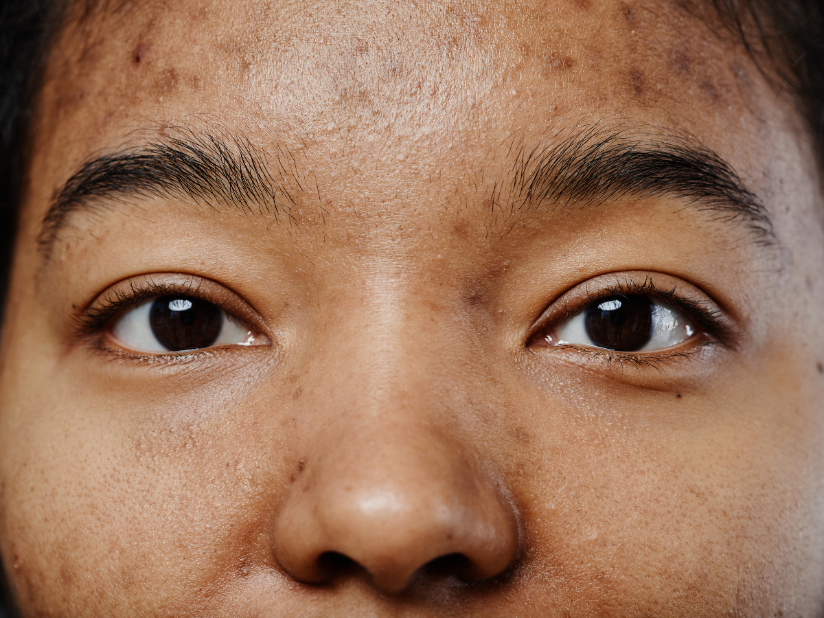 Tips menghilangkan Bekas Jerawat