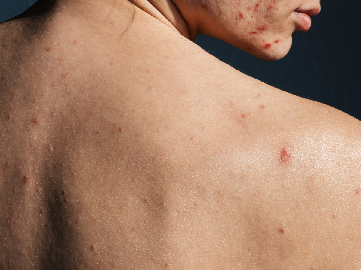 Jangan biarkan jerawat punggung menghalangi kepercayaan dirimu.