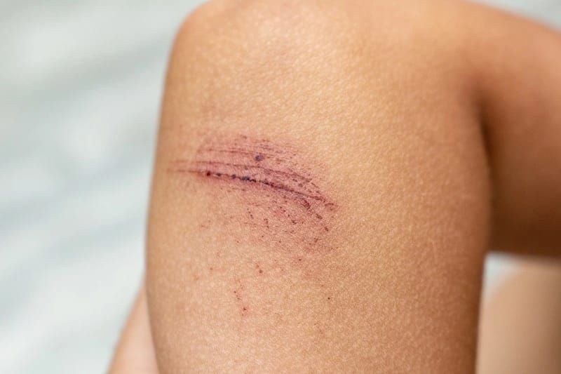 Punya bekas luka di badan sering bikin kurang percaya diri. Tapi tenang, banyak cara untuk bisa memudarkan bekas tersebut secara bertahap.