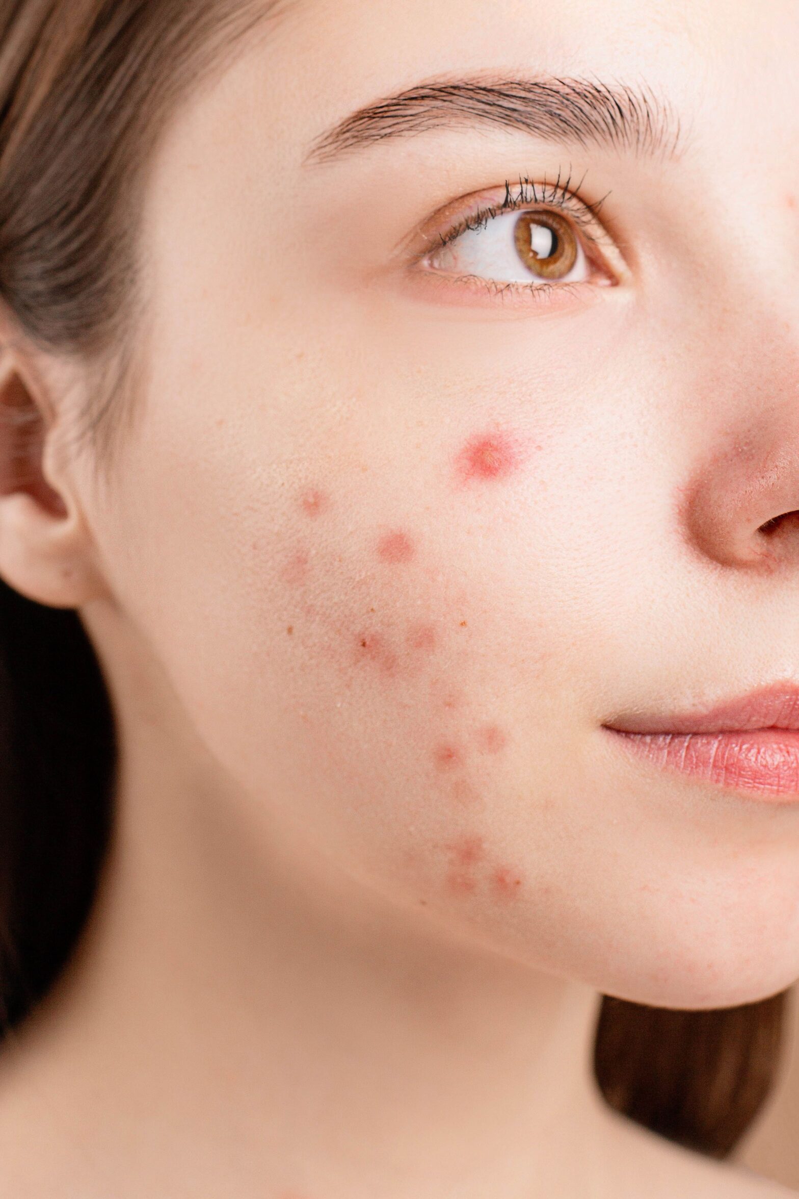 Dampak 'Fungal Acne' (Malassezia Folliculitis) vs Jerawat Biasa